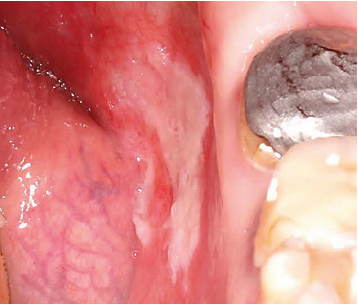 Aphthae on the floor of the mouth